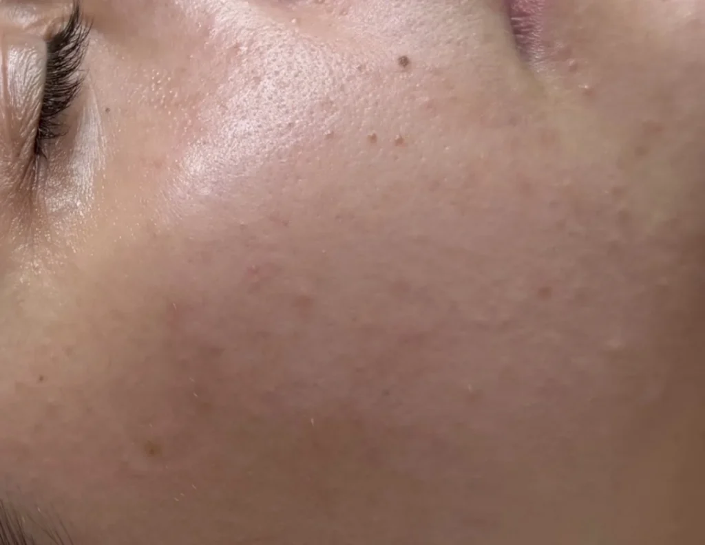 Mezoterapia igłowa – przed